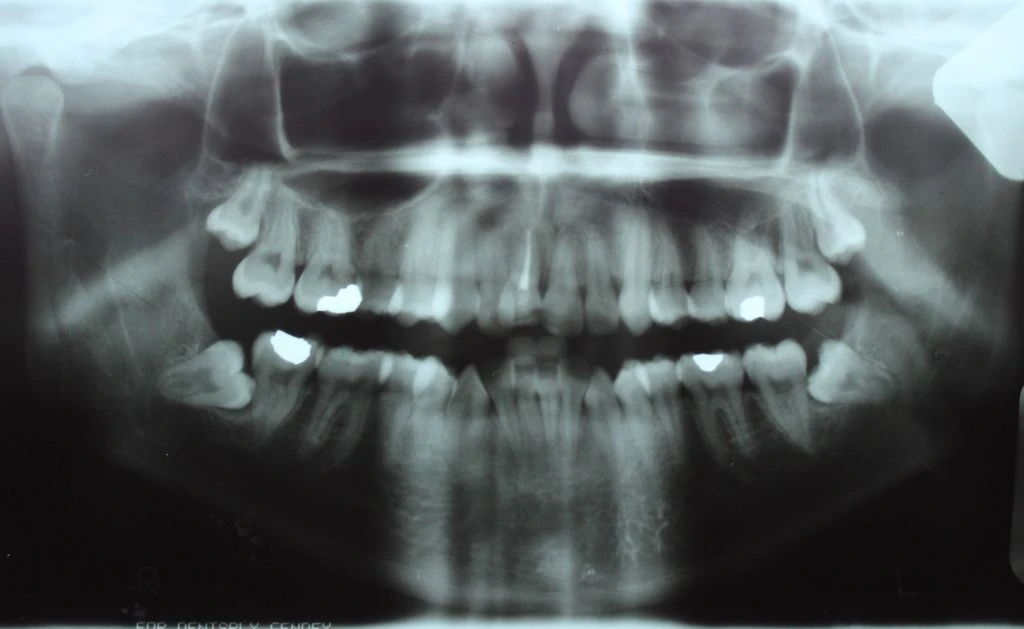 Cirurgia oral antes do tratamento
