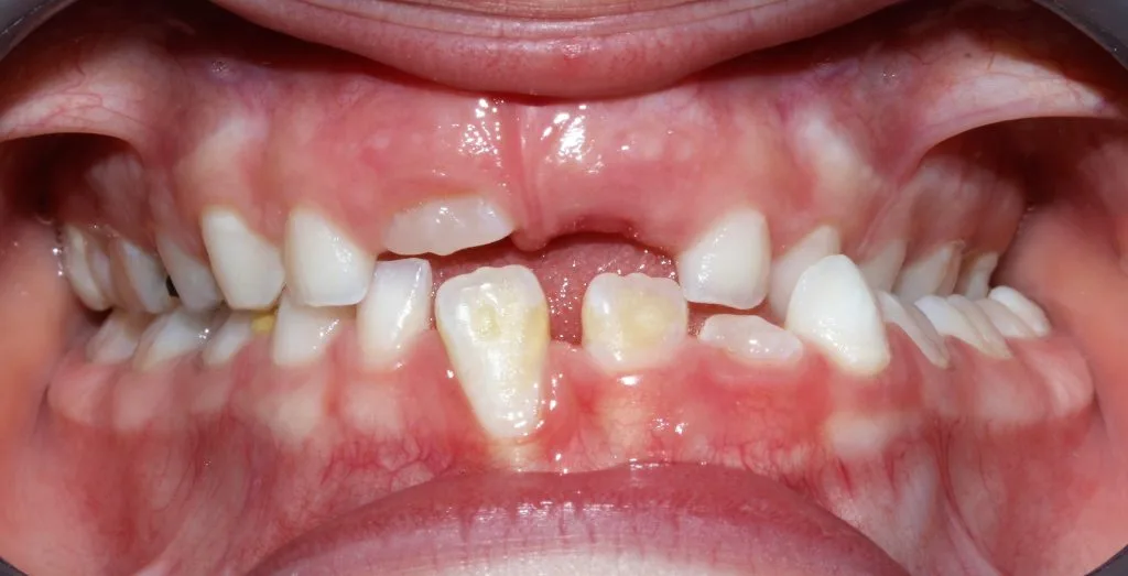 Odontopediatria antes do tratamento