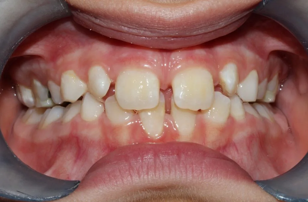 Odontopediatria depois do tratamento