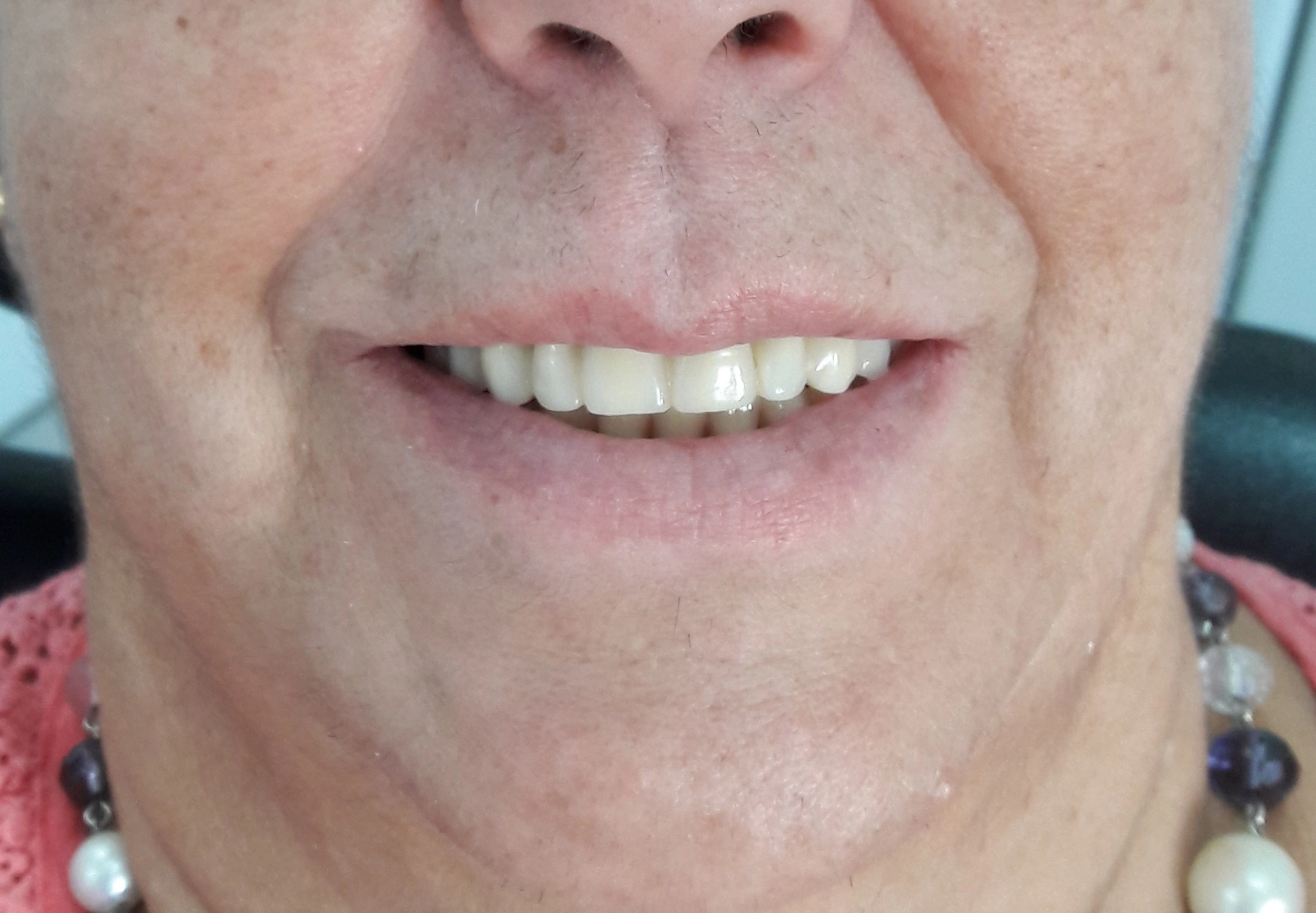 Prostodontia depois do tratamento